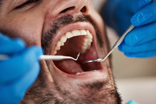 Best Emergency Treatment for Dental Infections or Abscesses in Costa Mesa, CA